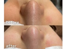 サージュクロレ 松戸店(sage colorer)/毛穴クリーンケア