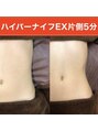 エメ(aimer) 【小顔&痩身ハイパーナイフEX】施術5分Before→After