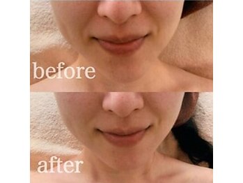 ブランシェ 金沢店 × 椿/シワ・たるみケア『30代お客様』