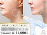 【岐阜初登場！】顔針なしピストル溶解液導入☆お好きな部位3本￥33,000→