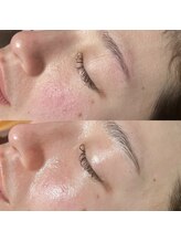 エルミオ エスパシオ ミロク(El mio espacio 369miroku)/カーボキシー～お顔編～