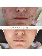 トリートメントルーム フェリーチェ(Felice)/手強い繰り返す大人ニキビに