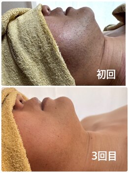 ティアレ 廿日市店(Tiare)/ビフォーアフター　爆抜け込み