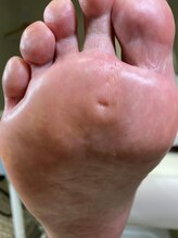 フットメンテ 巻き爪矯正センター 南浦和/魚の目　１回の施術後
