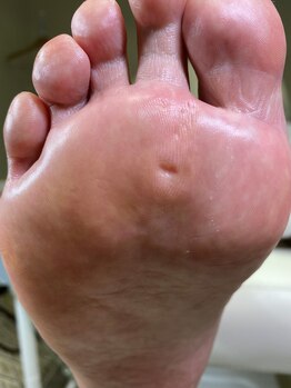 フットメンテ 巻き爪矯正センター 南浦和/魚の目　１回の施術後