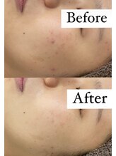 カルディエ(Cardie)/肌質改善　ビフォーアフター