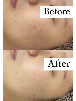 カルディエ(Cardie)/肌質改善　ビフォーアフター