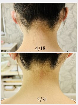 リラキュート(Rela Cute)/襟足脱毛の様子