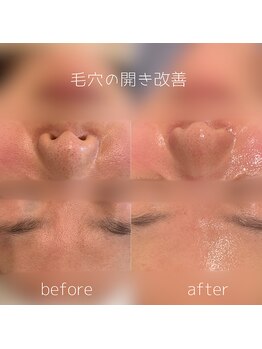 WA ネイル アンド ビューティー(WA nail & beauty)/水光ピーリング