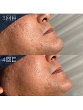 カナウ(KANAU)/ヒゲ脱毛（40代後半男性）