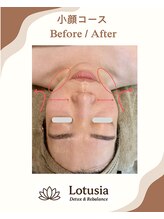 ルトゥーシア(Lotusia)/小顔　　before→after