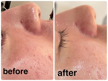 デューン 蕨店(Dune)/毛穴汚れ・角質【施術1回】