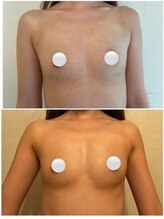 ベルビューティー(belle beauty)/【バストアップ☆育乳】◇症例◇