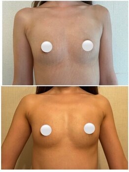 ベルビューティー(belle beauty)/【バストアップ☆育乳】◇症例◇