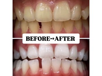 ホワイトニングサロン 豊中/Before&After美白ホワイトニング
