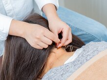 ハリナチュレ 南流山店/首、肩へ鍼で直接のアプローチ