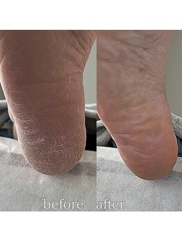 フットミー(foot mii)/