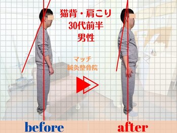 マッチ鍼灸整骨院/猫背・骨盤矯正で首肩こり解消