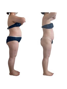 メリア(Mellia)/ぽっこりお腹も姿勢が原因かも