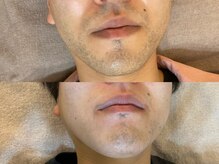 モンレーヴ(MonReve)/ひげ脱毛