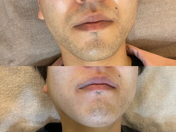 モンレーヴ(MonReve)/ひげ脱毛