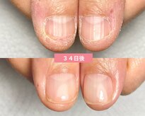 サンネイル(Sun nail)