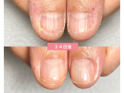 サンネイル(Sun nail)の写真