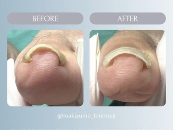 巻き爪補正店 天王寺店