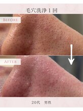 ル シャ/メンズ脱毛/毛穴洗浄/ヘッドスパ