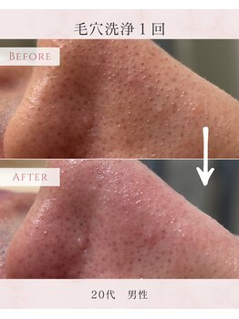 ル シャ/メンズ脱毛/毛穴洗浄/ヘッドスパ