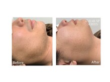 スタンド(STAND)/髭脱毛