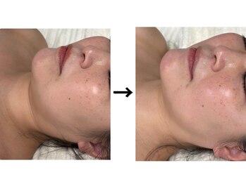 ドクターエイジレス(DR.AGELESS)/リアボーテフェイシャル1回