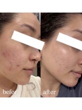 ビタザボナ(Vita the Bona)/幹細胞フェイシャル