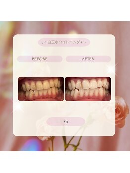 プラスビー 2号店(+b)/ホワイトニングビフォーアフター