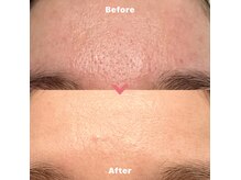 次世代ケア☆シリカマイクロニードルで毛穴の開き/黒ずみ改善