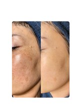 ソリッジ肌管理室/大人気TIPのシミケア