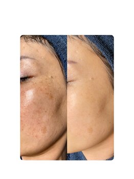 ソリッジ肌管理室/大人気TIPのシミケア