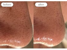 リスタ(RSTA)/【BEFORE/AFTER】