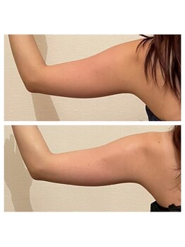 ボディーワークス 新町(BODY WORKS)/インディバで二の腕ケア