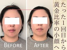スウ(suu.)/Before-After【30代】1回