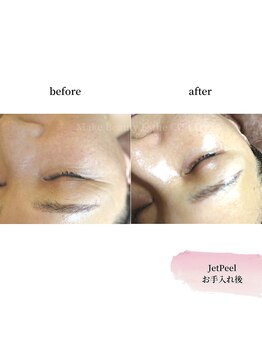 ココ センガ ビューティー クリニック(COCO SENGA Beauty-Clinic)/ジェットピールヒアルスキンボト