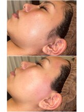 エースタイル(A-style.)/もみあげ☆シュガーリング脱毛