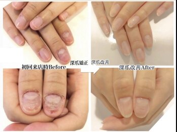 トイロ(toiro)/繰り返す深爪も美爪へ