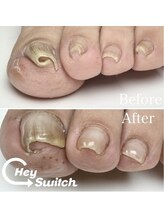 エンヴィ(ENVY)/効果絶大！巻爪ケア♪