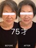 【春のお祝いキャンペーン】小顔/リフトアップ/ほうれい線ケア/肌質改善