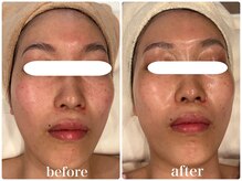 グレイス 高槻店(GRACE)/乳酸ピール3回目/結果写真