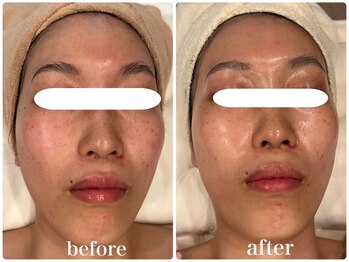 グレイス 高槻店(GRACE)/乳酸ピール3回目/結果写真