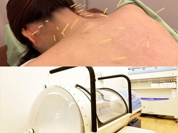 はしもと鍼灸整骨院/首こり肩凝りの鍼　酸素カプセル