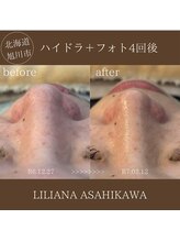 リリアーナ アサヒカワ(LILIANA ASAHIKAWA)/ハイドラ毛穴洗浄＋光フォト