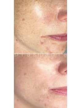 スーン(soon)/プラズマシミリセット